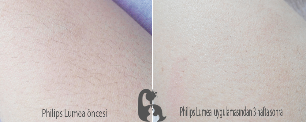Philips-Lumea-öncesi-sonrası-fotoğrafları