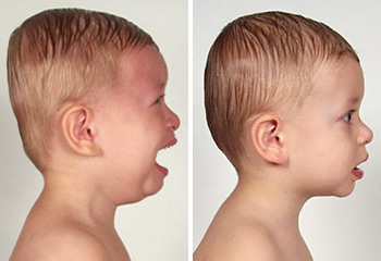 Bebeklerde düz kafa sendromu