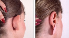 Kepçe kulak operasyonu kaç yaşında yapılır?